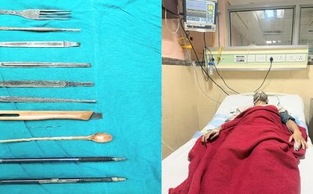 हैरत : डाॅक्टरों ने मानसिक रोगी के पेट से ऑपरेशन के जरिये निकाले छुरी-कांटे और पेन 
