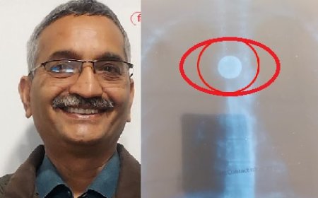 चमियाना में डॉक्टरों ने जटिल सर्जरी को अंजाम देते हुए 23 साल पहले निगले सिक्के को फूड पाइप से निकाला