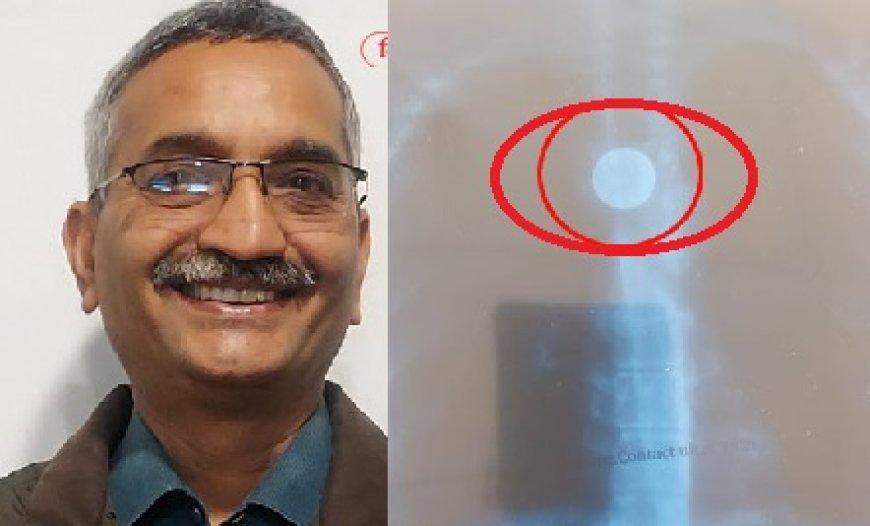 चमियाना में डॉक्टरों ने जटिल सर्जरी को अंजाम देते हुए 23 साल पहले निगले सिक्के को फूड पाइप से निकाला
